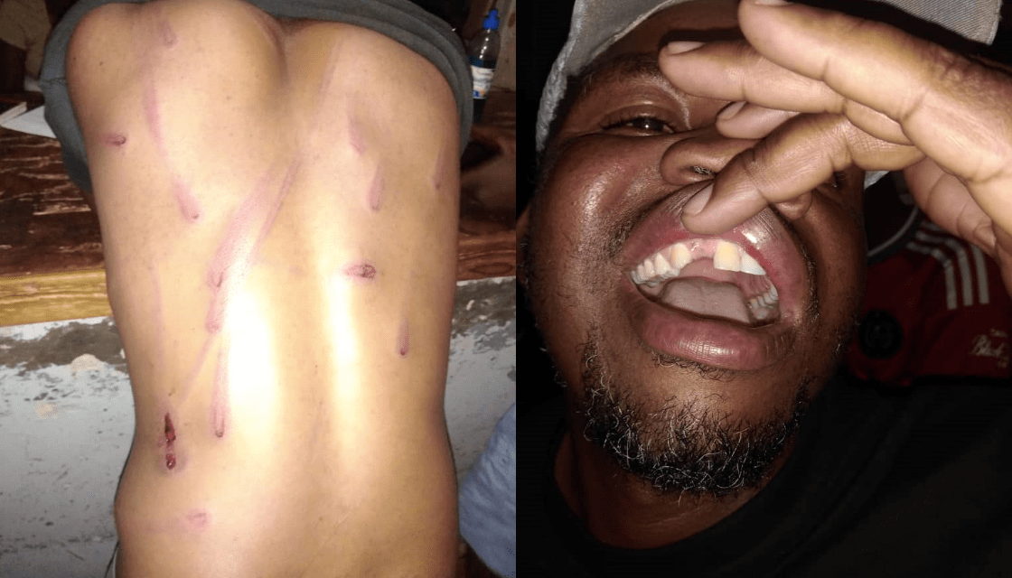 Bikita West CCC Activist Battles for His Life after Severe Assault by Zanu PF Members